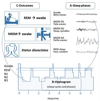 Lady Macbeth's Night Walking With Dissociative Symptoms Diagnosed by the First Sleep Medicine Record